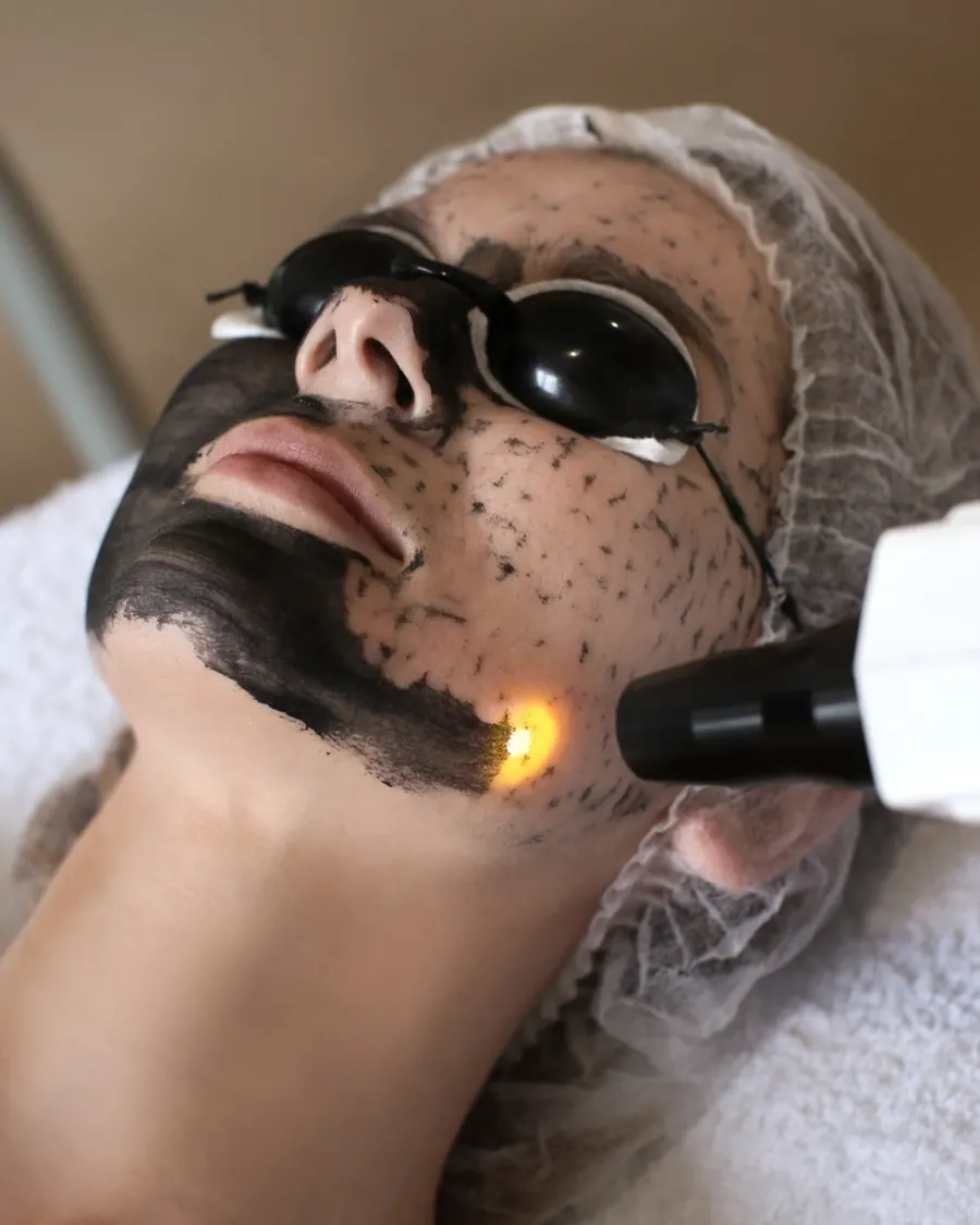 Carbon Laser Peel at Cinch Clinics